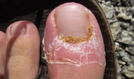 Le traitement de la mycose des ongles