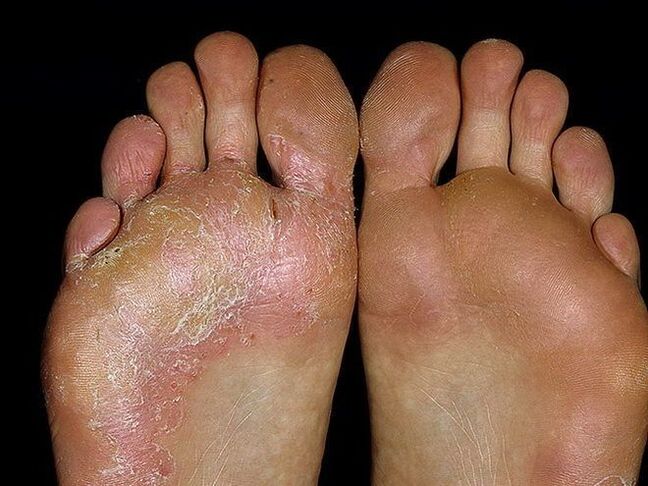 symptômes d'un champignon sur le pied