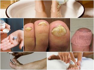 les mycoses des pieds traitement