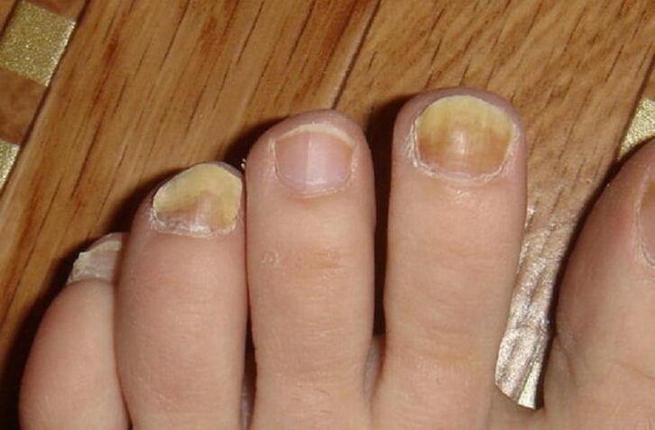 symptômes de champignons sur les ongles et la peau des pieds