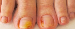mycose des ongles des pieds symptômes