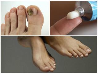 mycose des ongles des pieds traitement