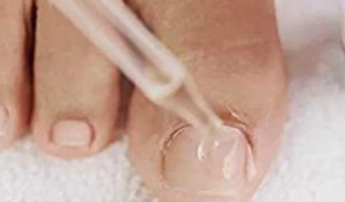Les gouttes de la mycose des ongles des pieds