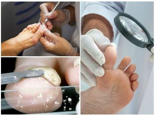 le champignon de la peau des pieds diagnostic