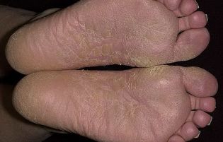 mycose des pieds